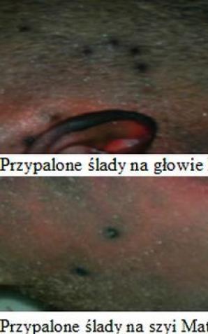 [VIDEO] Rutkowski: Mateusz Leszczyński został zabity dwoma lub trzema paralizatorami. Ich przytknięcie do głowy i szyi wywołało paraliż i uduszenie. Dlaczego Akademia Medyczna we Wrocławiu widząc charakterystyczne, głębokie i przypalone ślady, to ukryła?